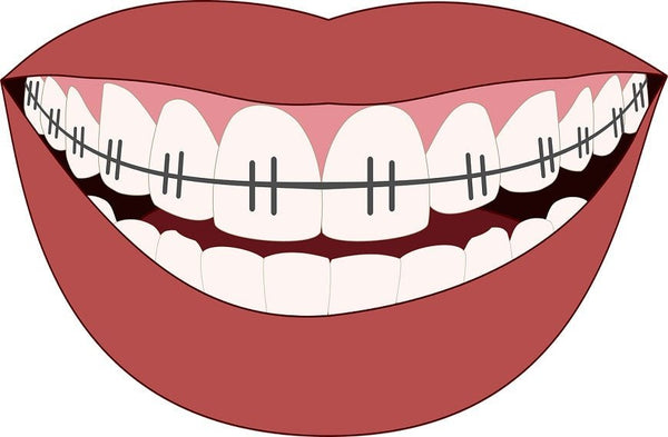 Appareil dentaire : comment bien se brosser les dents ? - Y-Brush