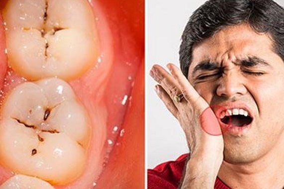 Tooth decay: causes and signs