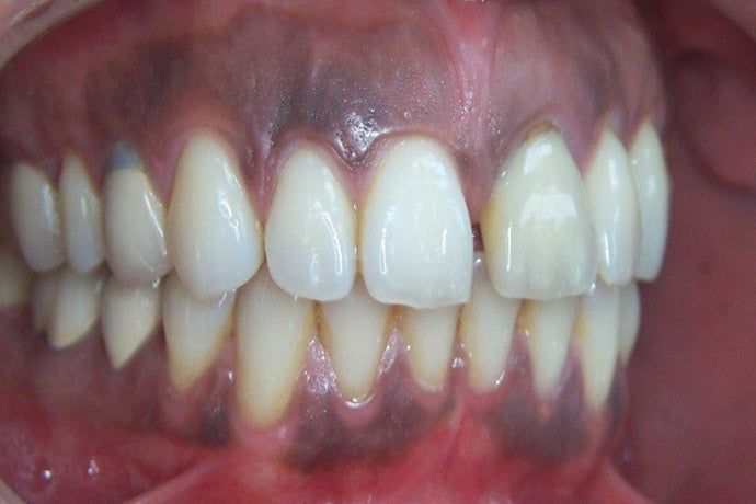 How to get rid of black gum disease? 