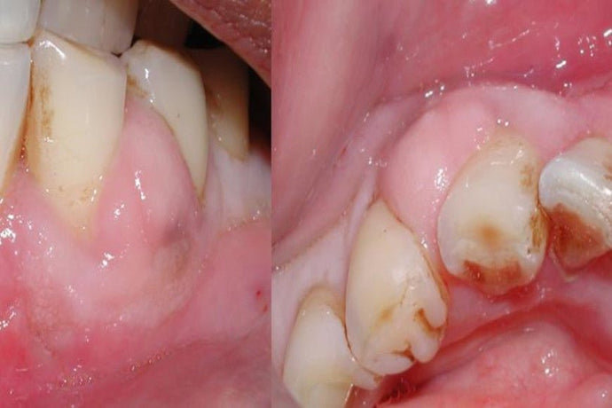 How to relieve a gum abscess with a mouthwash ?