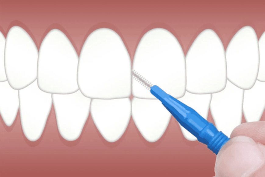La brosse interdentaire : pourquoi faut-il l'utiliser ? - Y-Brush