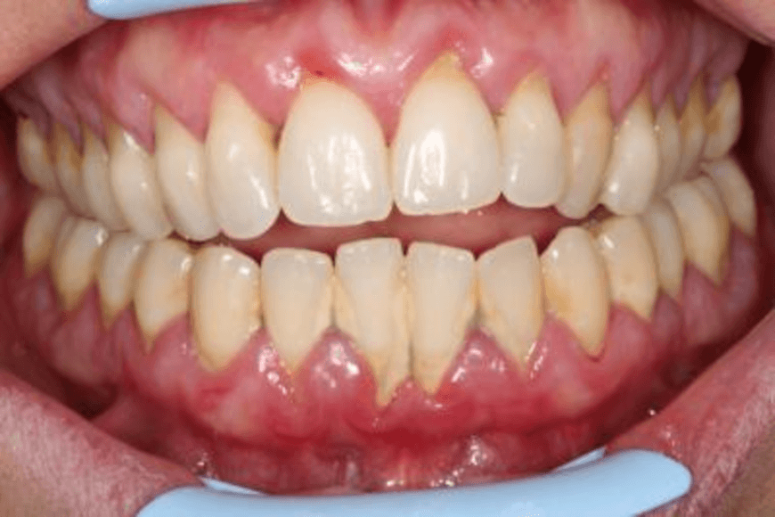Comment soigner une parodontite chronique ? - Y-Brush