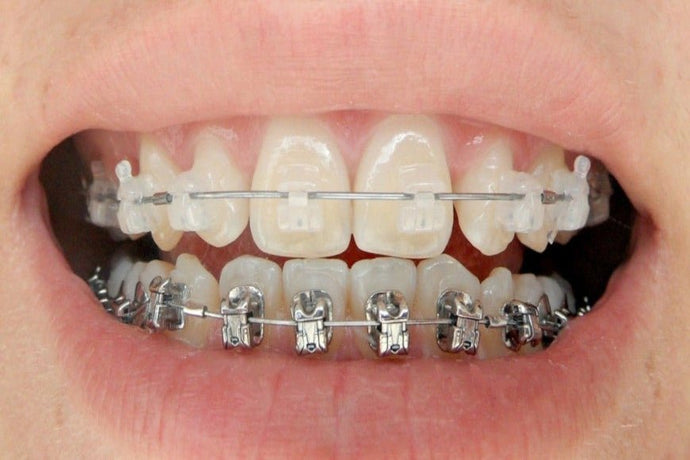 Braces: what to eat and how?