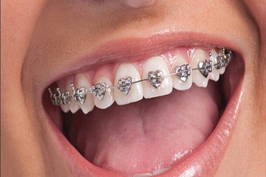 Braces advantages and disadvantages Y Brush