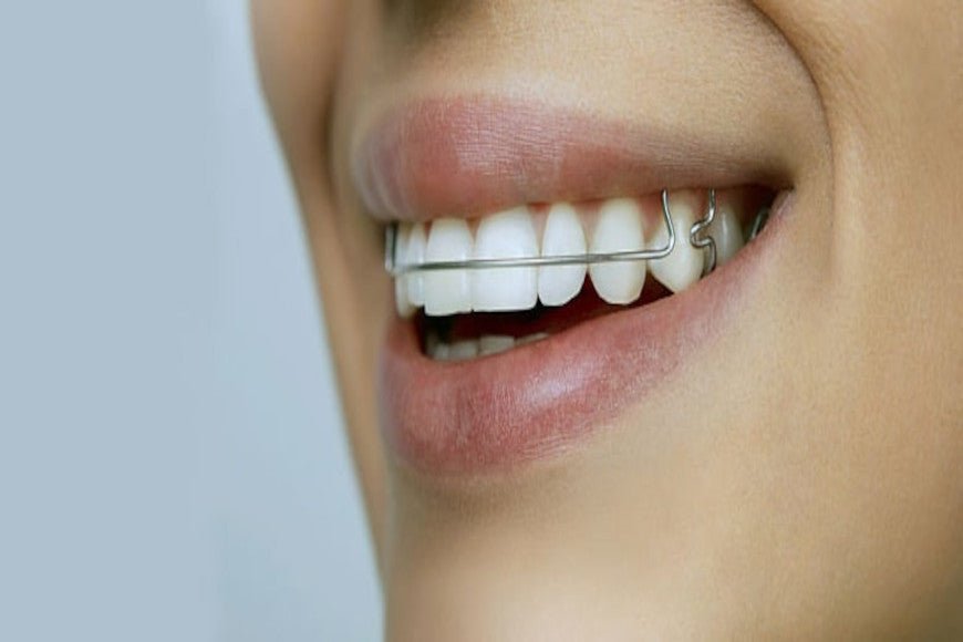 The price of braces