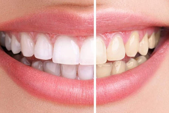 Whiten your teeth naturally