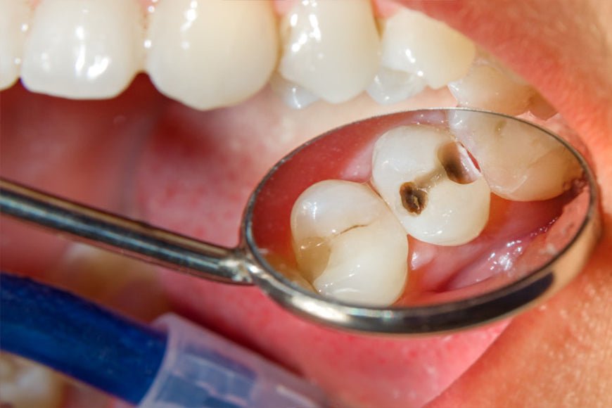 La carie dentaire - Y-Brush