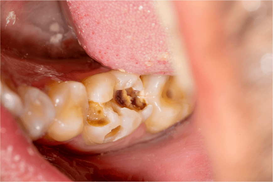 Que faut-il savoir sur la carie profonde ? - Y-Brush