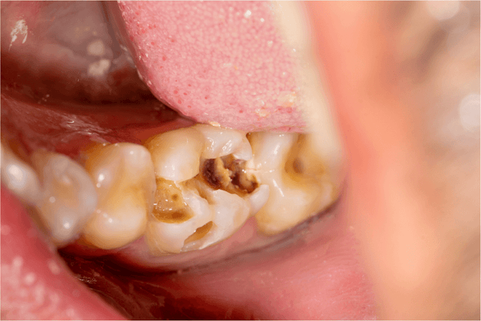 What do you need to know about tooth decays ?