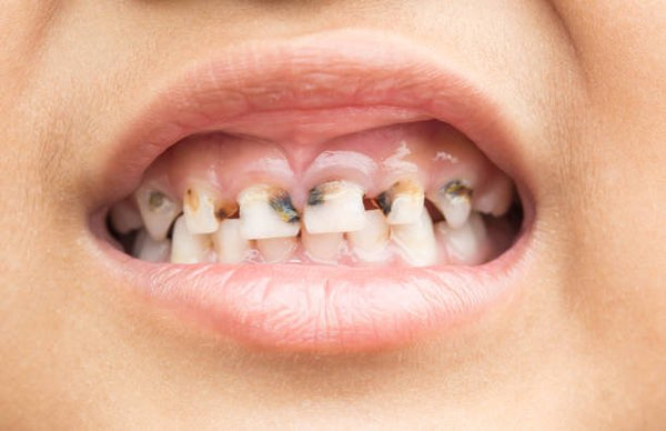Faut-il enlever les dents de lait cariées de votre enfant ? - Dentiste pour  Enfants