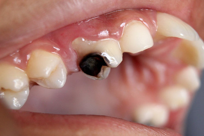 How to repair a molar broken by decay ?