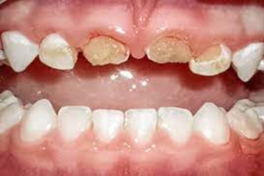 La carie du biberon - Y-Brush