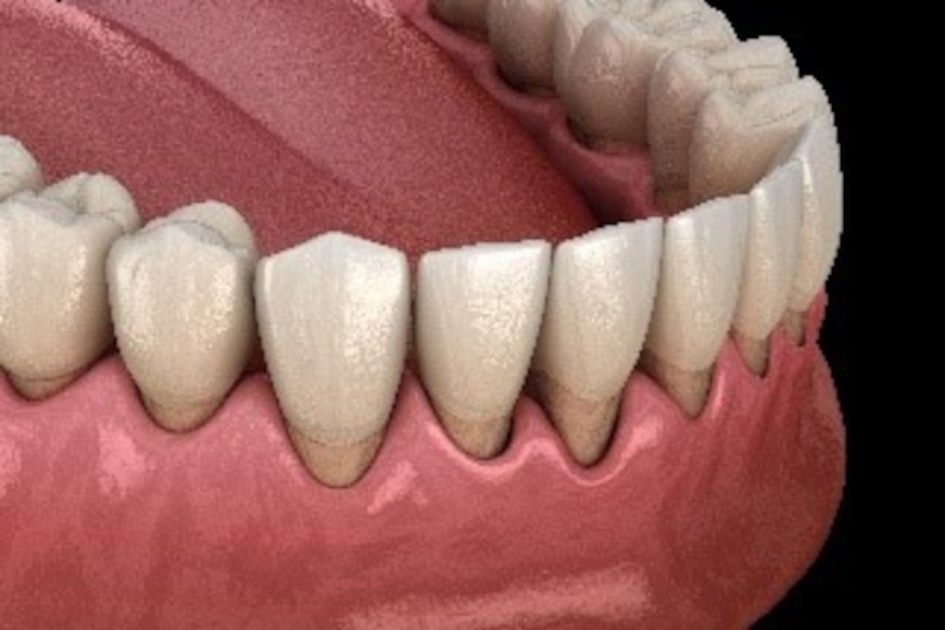 Qu'est-ce-que le déchaussement des dents ? - Y-Brush