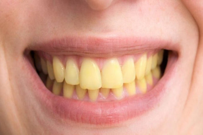 Avoir les dents jaunes c'est quoi ?