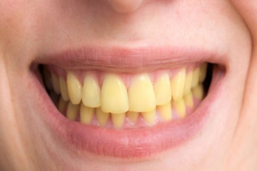 Avoir les dents jaunes c'est quoi ? - Y-Brush
