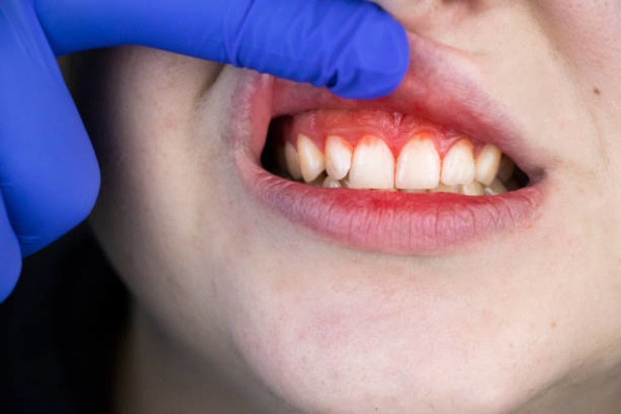 Gencive inflammatoire : Comment aller mieux ? - Y-Brush
