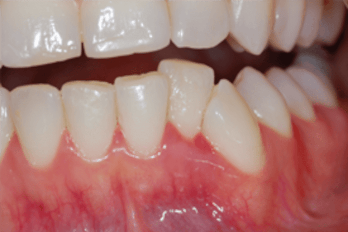 Acute gingivitis: all you need to know