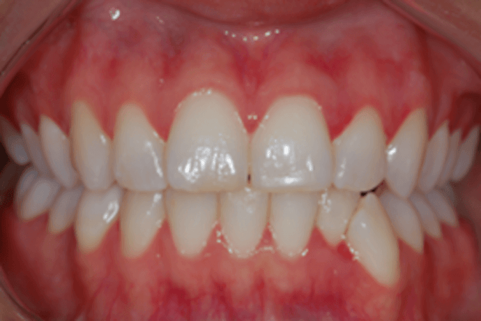 Is gingivitis contagious: what you need to know?