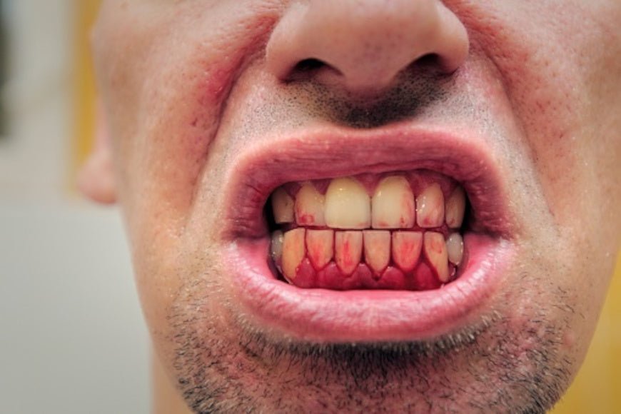 Gingivite : ne plus ressentir aucune douleur - Y-Brush
