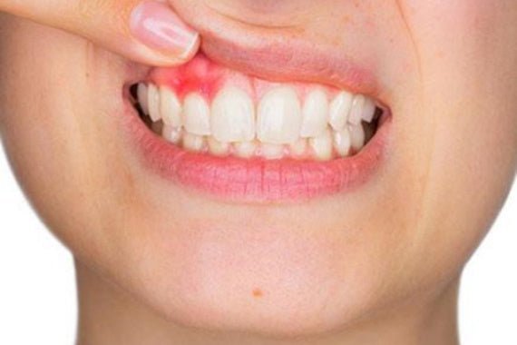 Découvrez ce qu’est la gingivite et comment l’arrêter - Y-Brush