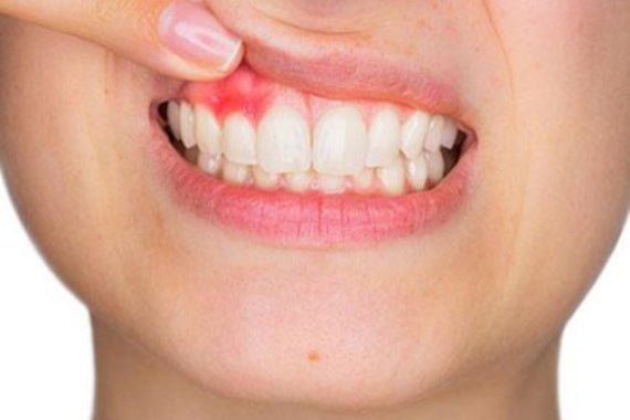 Find out what gingivitis is and how to stop it