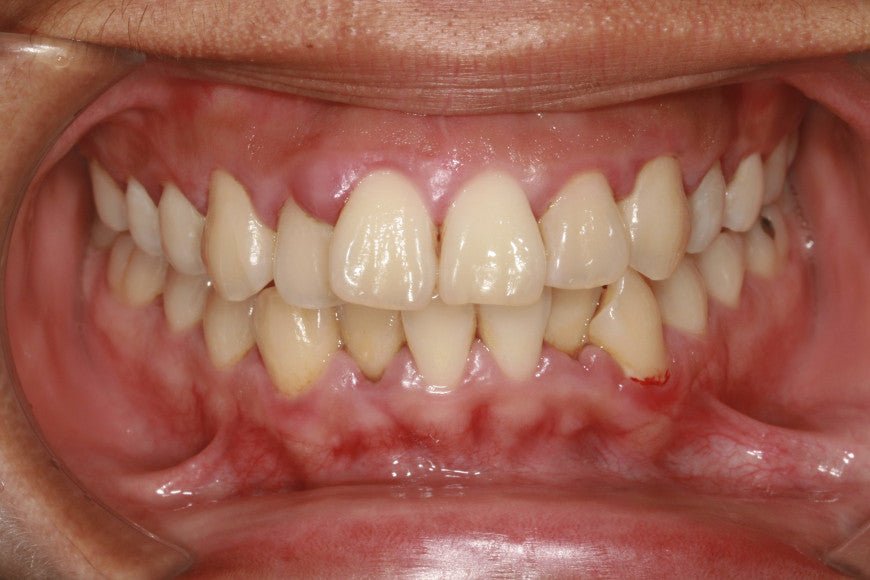 Quel antibiotique contre la gingivite ? - Y-Brush