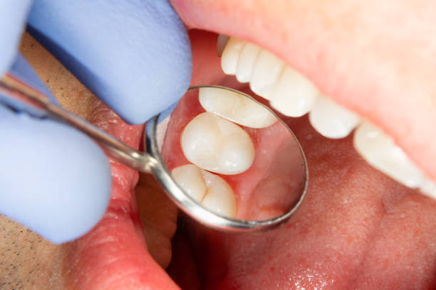 Dites Non aux Caries : Astuces et Conseils pour une Prévention Efficace