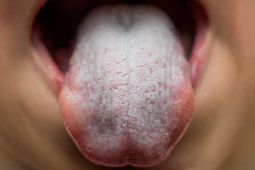 Bain de bouche contre la mycose : est-ce une solution efficace ? - Y-Brush