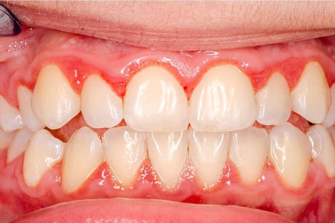 Can periodontitis be treated with laser?