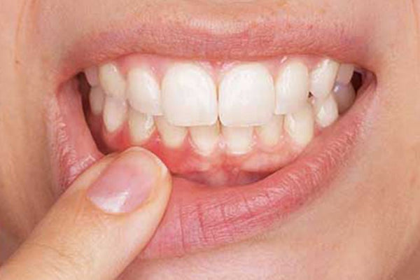 La parodontie : comment se déroule le traitement de la parodontite ? - Y-Brush