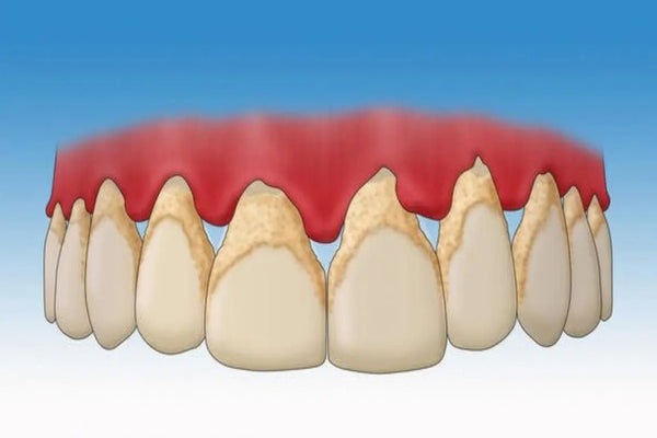 plaque dentaire