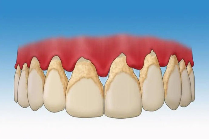 Dental plaque: What is it?