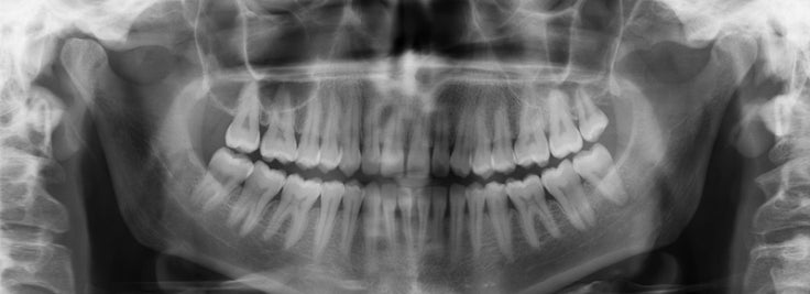 The panoramic dental X-ray in case of tooth decays