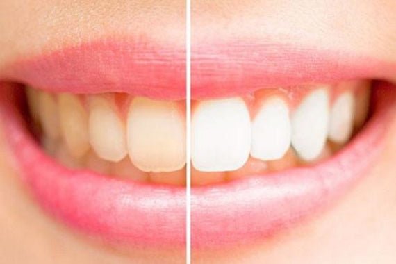Que faut-il manger pour avoir des dents blanches ? - Y-Brush