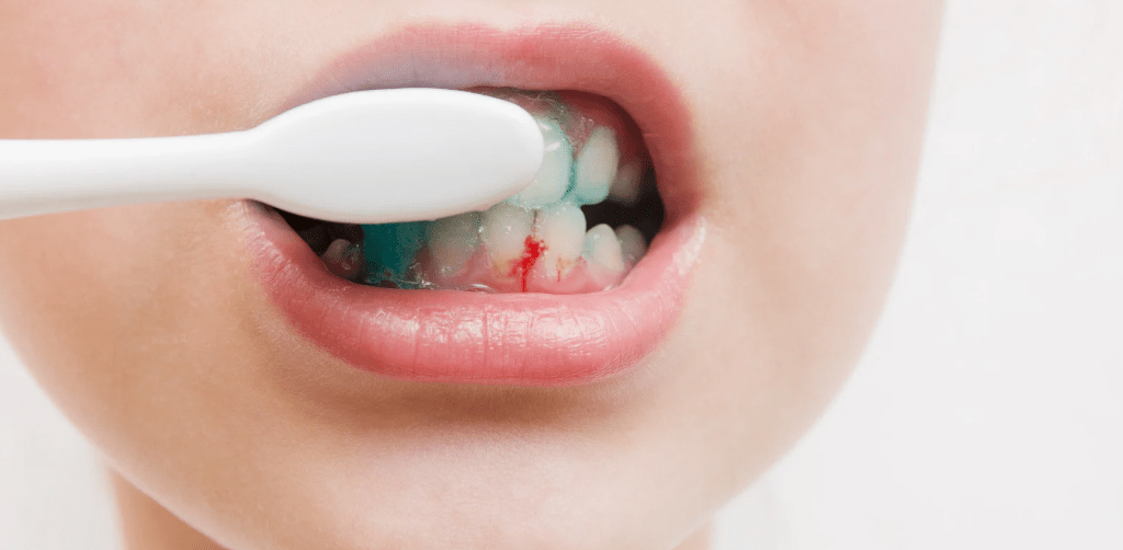 Que faire en cas de saignement des gencives lors du brossage ? - Y-Brush