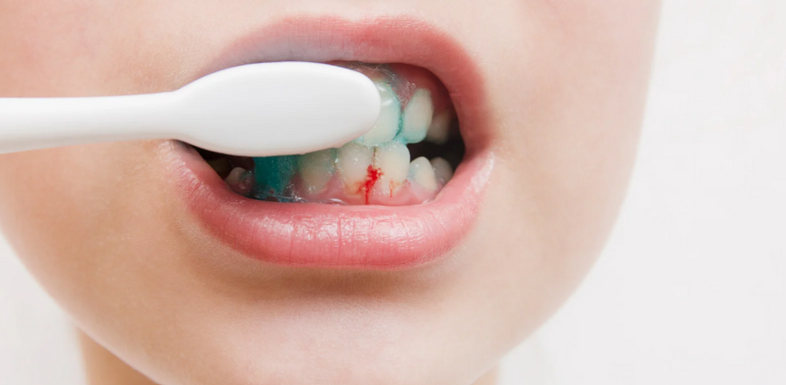 Que faire en cas de saignement des gencives lors du brossage ?