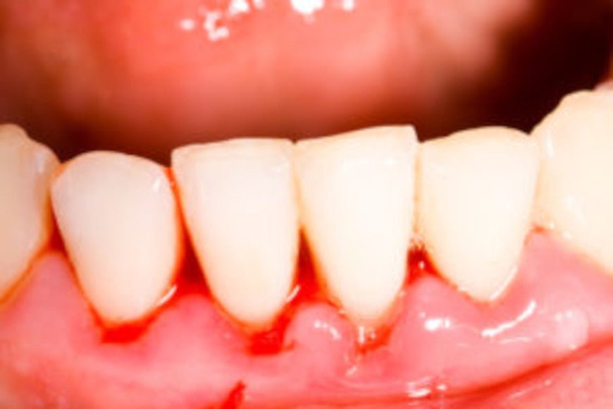 Se réveiller avec du sang dans la bouche - Y-Brush