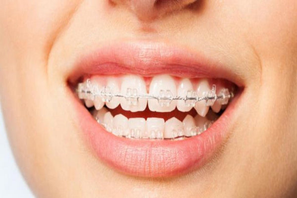 matériel dentaire problème bucco-dentaire