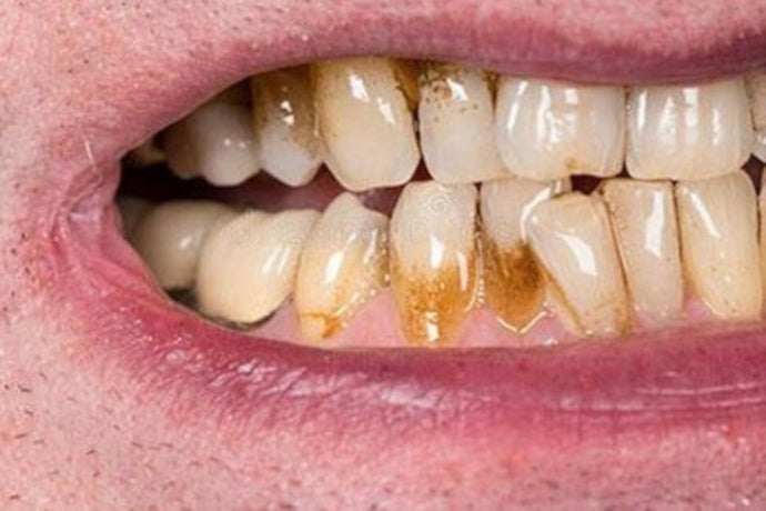 Removing brown stains from teeth
