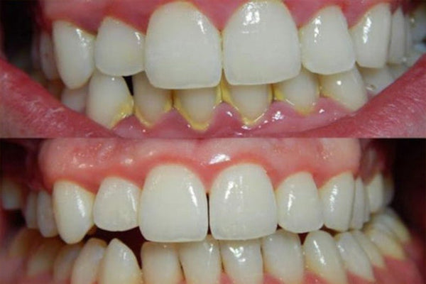 Comment enlever le tartre de ses dents et prévenir son apparition ? - Y-Brush