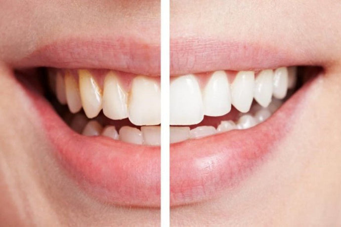 What is tartar on teeth?