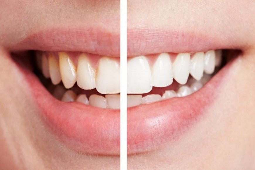 Qu'est-ce-que le tartre sur les dents ? - Y-Brush