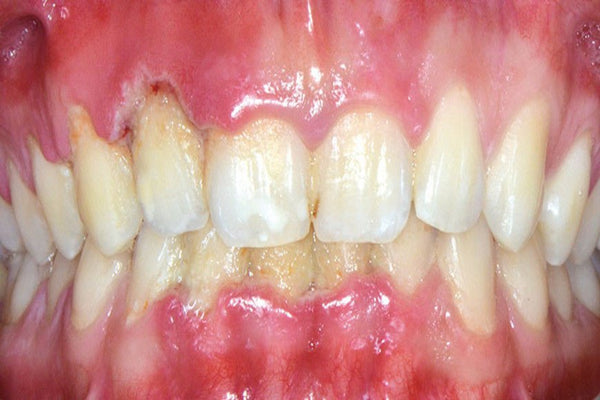 parodontite ulcéro-nécrotique