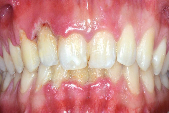 All about ulcerative periodontitis