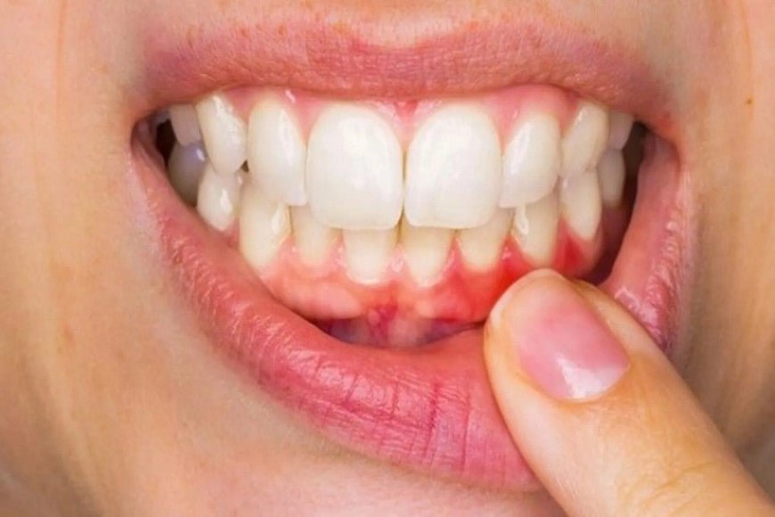 Quels sont les symptômes d'une gingivite ? - Y-Brush